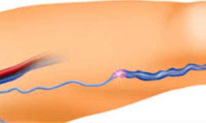 التهاب وريدي