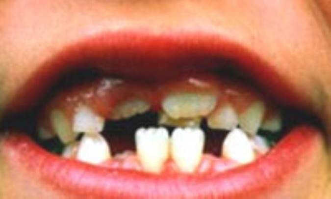 فضانگهدارنده‌ها به‌جاي دندان‌هاي شيري