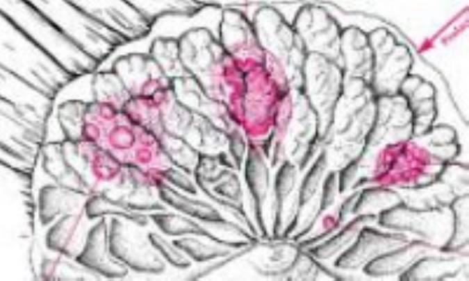 ترشح سینه و درمان آن