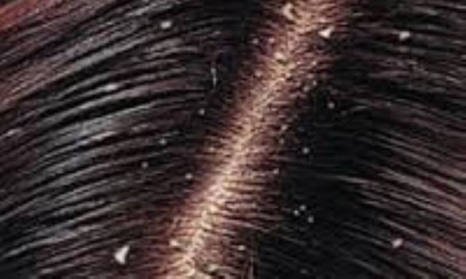 مهمان ناخوانده موها