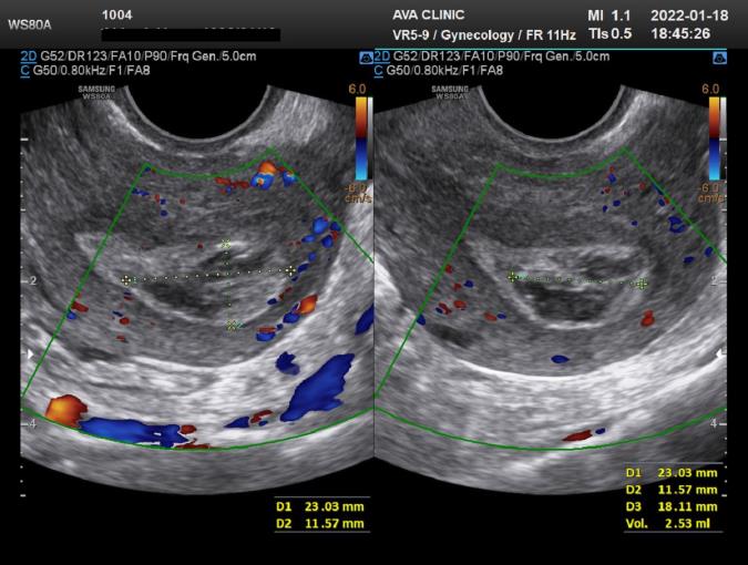 چگونگی تفسیر سونوگرافی بقایای بارداری