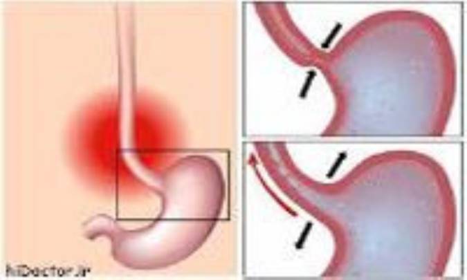 علائم سوء هاضمه
