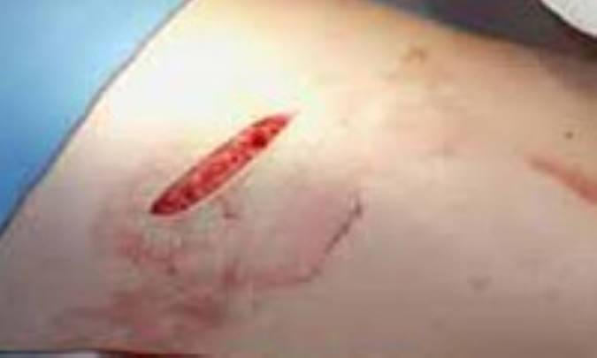 زخم جراحت، دمل و درمان آن