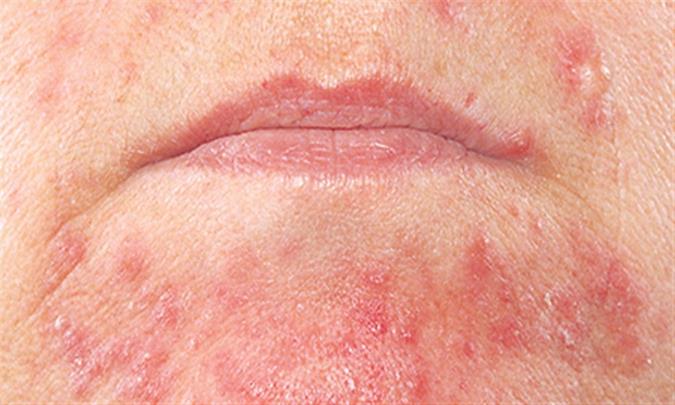 درماتیت استازیس چیست و چگونه درمان میشود؟