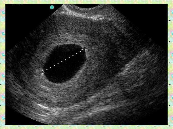 هر آنچه که باید درباره بارداری پوچ بدانید
