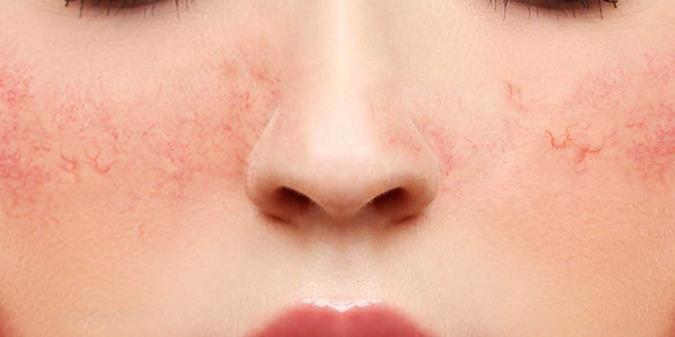 پوست خشک و نحوه پاکسازی آن با آلوئه ورا