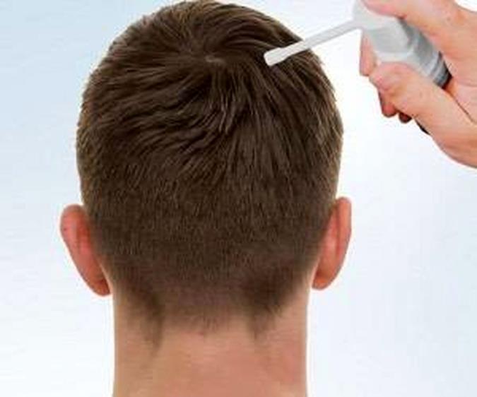 ریزش مو و درمان های آن