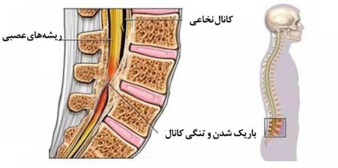 تنگی کانال نخاعی و درمان آن