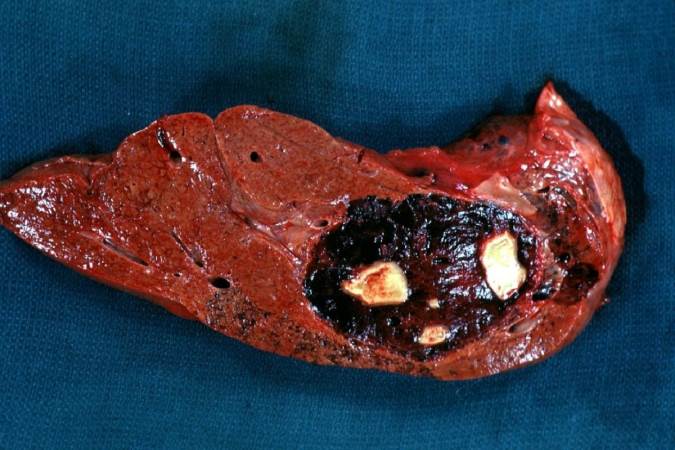 علامت‌ها و روش‌های درمان متاستازهای جگر