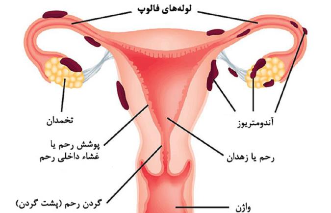 اندومتریوز از علل و علائم تا تشخیص و درمان