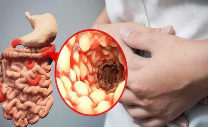 بیماری کرون، انواع آن و نحوه درمان این بیماری التهابی روده