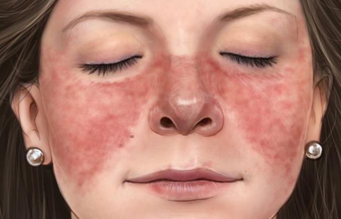 نشانه های اولیه بیماری لوپوس عوامل و راه های درمان آن