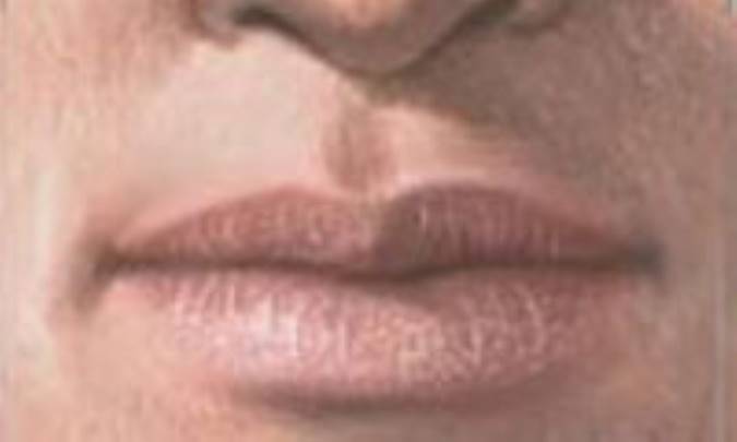 درمان خشکي لب