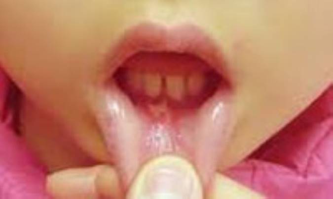 وجود تبخال در دهان