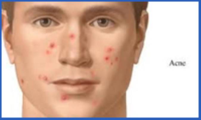 ویتامین C برای آکنه