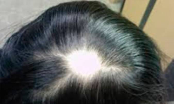 علل تشکیل لکه‌های طاسی در زنان