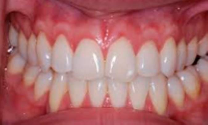 ویتامین‌های لازم جهت داشتن لثه‌هایی سالم