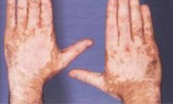 انواع سوختگی درجه یک، دو و سه