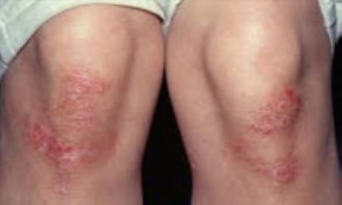 درمان خراشیدگی یا کنده شدن پوست زانو