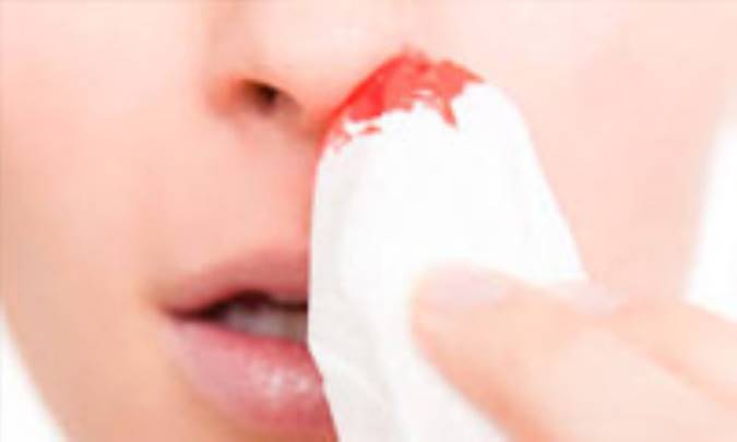 سردرد و خونریزی بینی