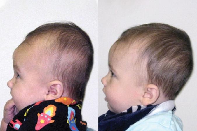 سندرم صافی سر چیست؟