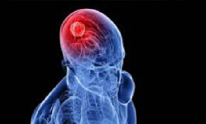 علائم سرطان مغز