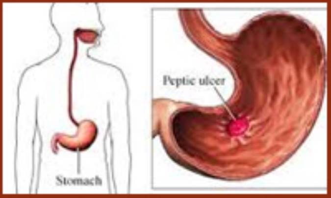به هنگام ابتلاء به گاستریت یا ورم معده چه باید خورد