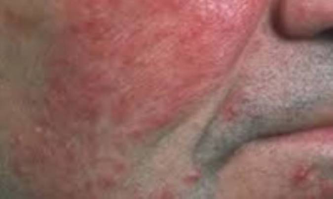 علت آکنه بزرگسالان چیست؟