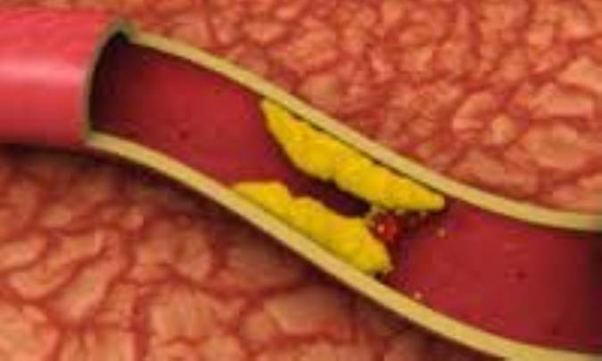 سطح بالای تری گلیسرید