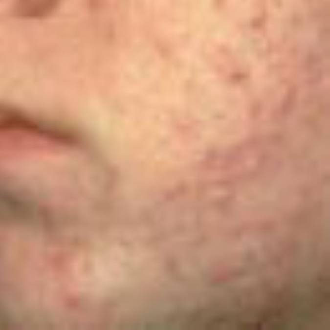 آكنه؛ شناخت و شيوه هاي درمان (1)