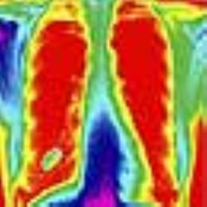 آمفيزم‌(Emphysema)