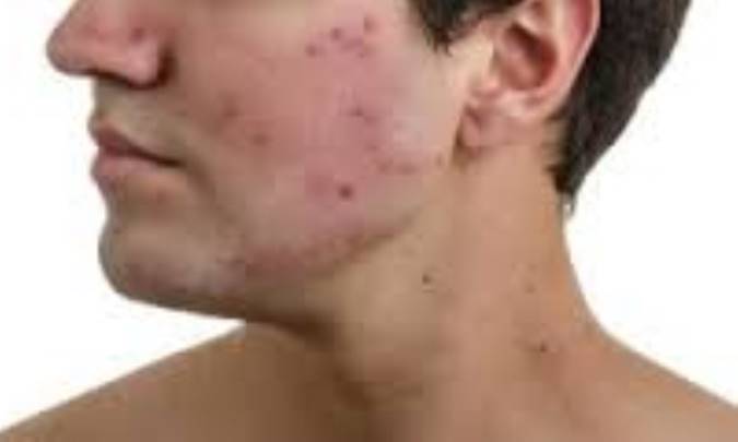معالجات طبیعی آکنه