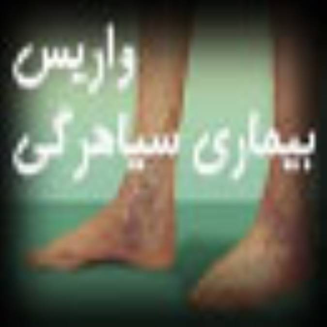 واریس بیماری سیاه‏رگها