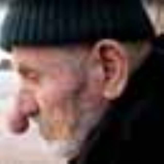 عوارض زيبايي در جراحي بيني