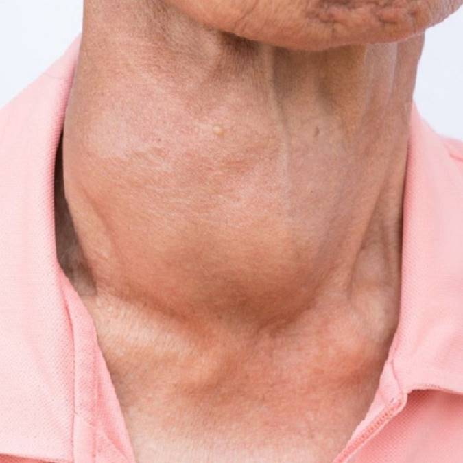 بیماری گواتر چیست و علائم آن چه می باشد؟