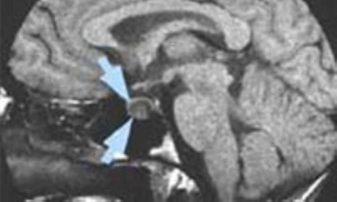 تومورهاي‌ هيپوفيز