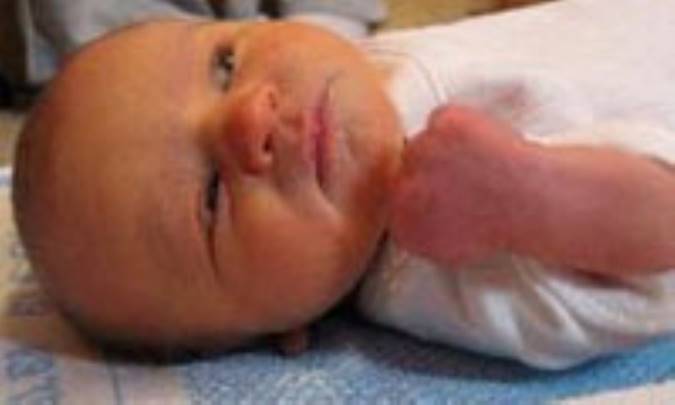 زردي يا يرقان در کودکان