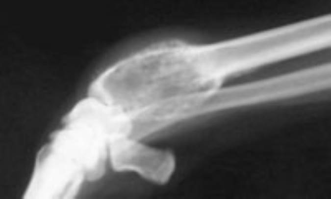 سرطان استخوان (Bone Cancer)