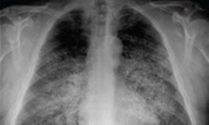 بيماري قلب ناشي از مشكل ريه (پرفشاري خون ريوي)