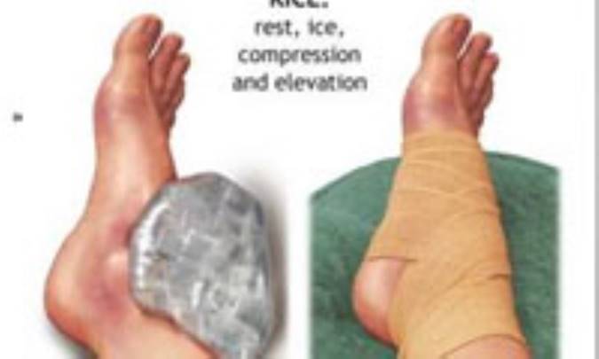 پيچ‌خوردگي پا؛ روش‌هاي مداوا