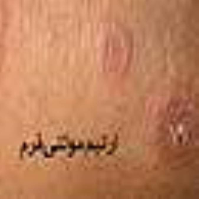 اريتم‌ مولتي‌فرم:‌ Erythema multiforme