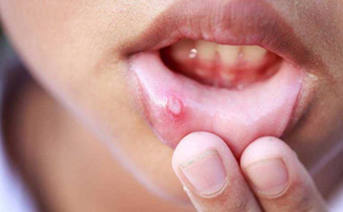 آیا آفت دهان همان تبخال است؟