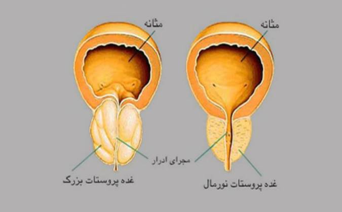 ده باور نادرست درباره‌ی سرطان پروستات
