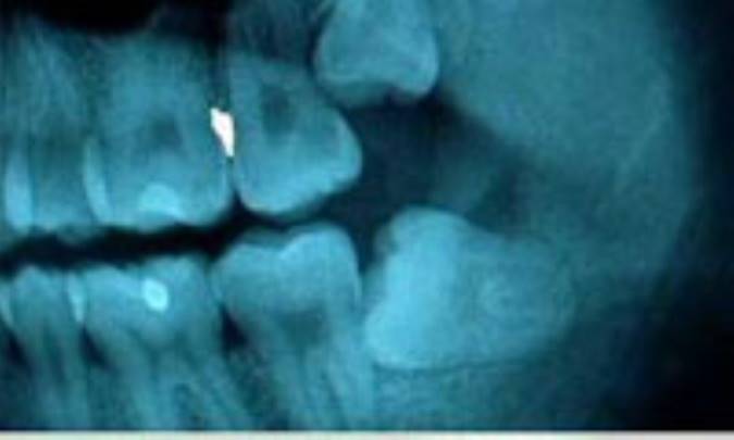 هر دندان عقلي را نبايد کشيد