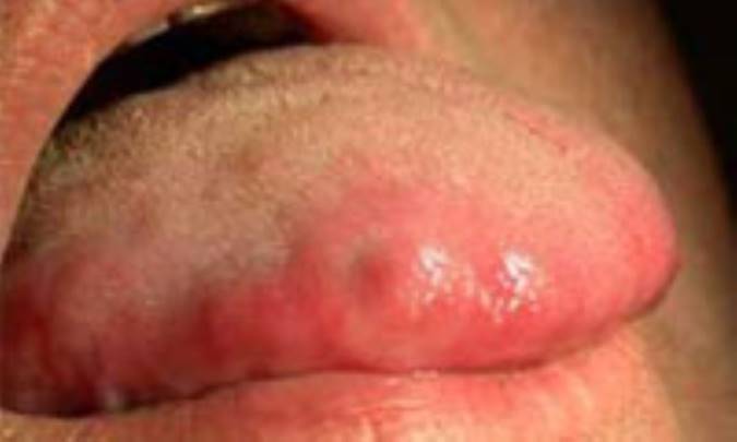 التهاب‌ زبان‌ (گلوسيت‌)