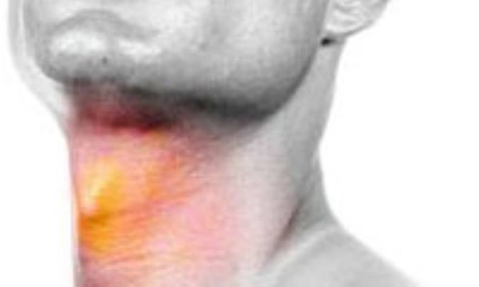 لارنژيت در يک نگاه