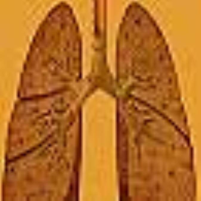 بلاستوميكوز(Blastomycosis)