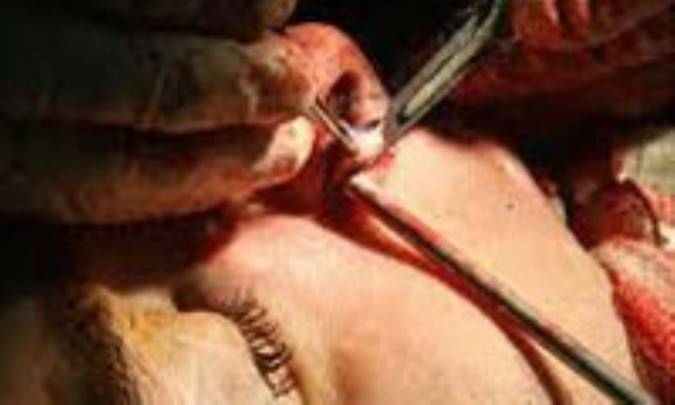 از جراحي پلاستيک بيني (رينوپلاستي) بيشتر بدانيم