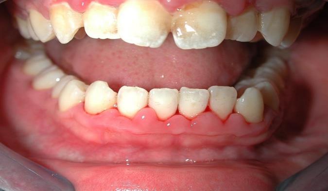 همه جیز راجع به بیماری اسکوروی