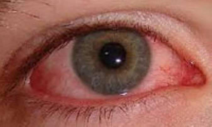 تابستان، شنا،استخر و ... قرمز چشم